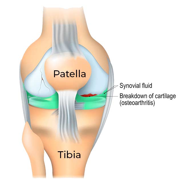 KneeCushionGraphic-1 KneeCushionGraphic-1